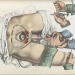 과학,<b>지식</b>) 1800년대 외과 수술