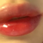 <b>새우</b>알레르기 때문에 입술 2배댐