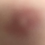 썅 모기<b>물림</b>;; ㅅㅂ