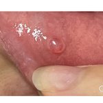 혐?)입안에 <b>물집</b> 레전드임