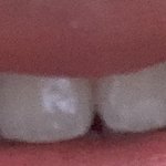 [방탈죄송] <b>덧니</b> 교정 필수일까요