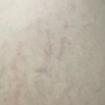 [댓글부탁해] (혐주의) 이거 튼살 맞지..ㅠㅠ