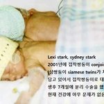어느 접착 <b>쌍둥이</b>의 17년 후...