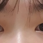 애드라... 나<b>쌍수</b>하는게낫겟지..??ㅠㅠ 제발조언좀해줘ㅜㄴ