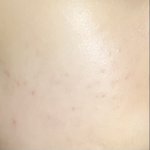 내 피부에 여드름 흉터 <b>남음</b>…