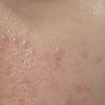[약혐] 얘들아 나 피부 좀 좋아짐…