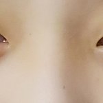 나 쌍수할까?