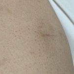 <b>야들</b>아 이게 모공각화증이여?