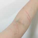 아니 ㄹㅇ 두드러기 <b>원인</b>이 뭐임