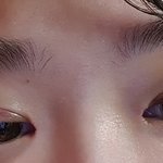 [댓글부탁해] <b>쌍수</b>+앞트임했는데 망한걸까..?? 해본애들 도와주라ㅠㅠ