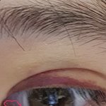 [댓글부탁해] 앞트임후 <b>누호</b>?땡김.. 이거정상이야?