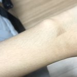 [드루와] 알바하다가 팬에 데여서 살 <b>익음</b>