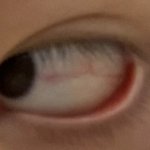 이거 눈 <b>실핏줄</b> 터진거임??