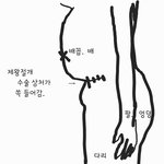 제왕절개 수술 후 상처가 <b>함몰</b> 되었어요.