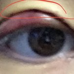 쌍수 <b>눈두덩</b>이 붓기 언제 빠져…?ㅠㅠ