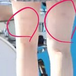 [모두드루와] 이거 지방<b>흡입</b>? 자국인가?