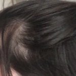 헤어라인 ㅈㄴ 심각하다