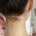 부산 표피종 수술 후 경과 억울해요