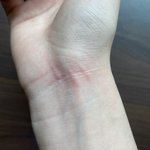 [도와줘] 긁혔는데 피부가 이상함
