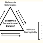 지루성두피염 관리법 (샴푸 개발자 피셜)