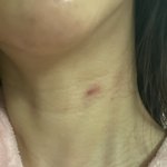 쇼핑몰 퍼플리쉬 <b>미백</b>스프레이 사용후 흉터 8개월째 사라지질않네요