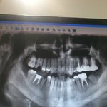 약10년동안 오른쪽 치아로 음식을 씹은적이 없습니다.지금은 양쪽모두...