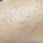 [이것좀봐줘] 나 여드름 <b>압출</b>받고 아렇게됬더든?