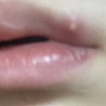 [댓글부탁해] 약혐주의) 나 <b>입술</b>에 여드름 났는데 이게 뭐야?
