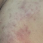 [이것좀봐줘] 야 진짜 여드름 <b>흉터</b> 어캄