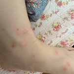 [댓글부탁해] 한쪽 다리에만 모기 30방 <b>물림</b> ㅋ......