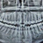 [ㅇㅇ] 사랑니 4개 한번에 <b>발치</b>해도되겠지?