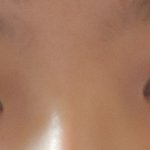 쌍수후기 앞트임이랑 절개 <b>비포</b> 애프터