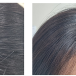 산후탈모 극복기