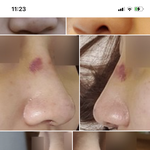 [드루와] 코수술 해본 애들 없나