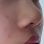 [댓글부탁해] 미성년자 입술 <b>필러</b>