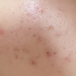 피부과 말고 여드름 <b>흉터</b> 없애는법좀 ㅈㅂ 약혐