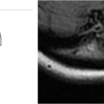 뇌 <b>mri</b> 찍었는데 이물질 발견했어요.