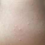 [NCT드림] ㅅㄷ 이런 여드름 어케 해야대ㅠㅠ