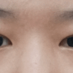 얘들아 나 절개쌍수 8주찬데 라인 더 ㅈㄴ낮아질까?