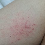 <b>모기</b>물리고 이렇게 되는 사람있어요?
