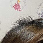 시술 후 머리가 모두 끊겼으나 <b>소보원</b>에 신고 하라고 합니다 + ...