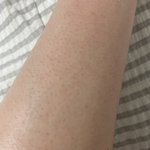 [댓글부탁해] 다리 <b>모공</b>이 빨개