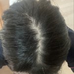 <b>사진O</b>) 나 탈모인 거 같은데 어떡하지