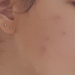 ㅆㅂ나 얼굴에 모기<b>물림</b>