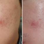 혐주의! 화농성 여드름으로 수십가지 써본후기