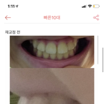 [댓글부탁해] <b>치아</b> 재교정 2년차인데 이제 빼도 되는지 알려줘....