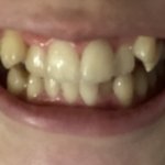 [댓글부탁해] 얘들아 대박 나 <b>덧니</b>좀 봐