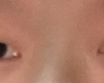 [19] 중3겨울방학에 쌍수하는거 에바임??