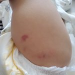 이거 <b>무슨</b>상처인지알<b>수</b>있는사람있을까요