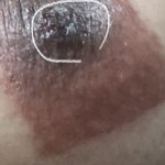 [드루와] 혹시 <b>메디폼</b> 써본 사람 있어...?ㅠㅠ